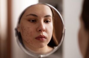 Как выбрать средства от постакне: советы и рекомендации