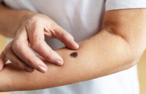 Почему лечение меланомы иммунотерапией стало стандартом?